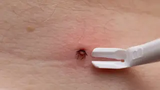 Urwany kleszcz w skórze, tuż obok białego przyrządu do jego usuwania.