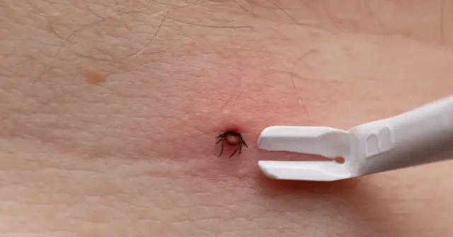 Urwany kleszcz w skórze, tuż obok białego przyrządu do jego usuwania.